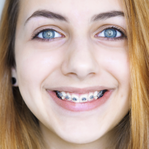 chica brackets metálicos