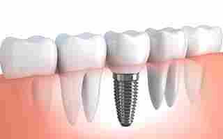 implante dental2
