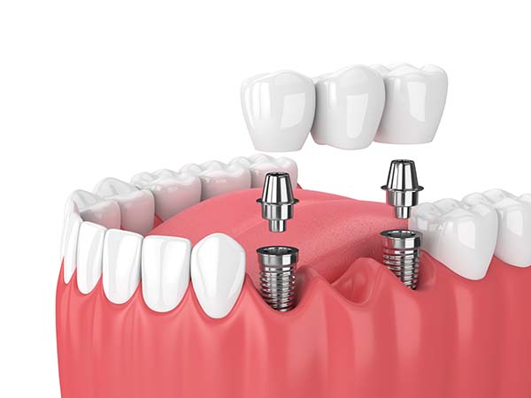 implante dental con puente