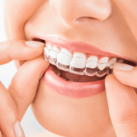 Invisalign