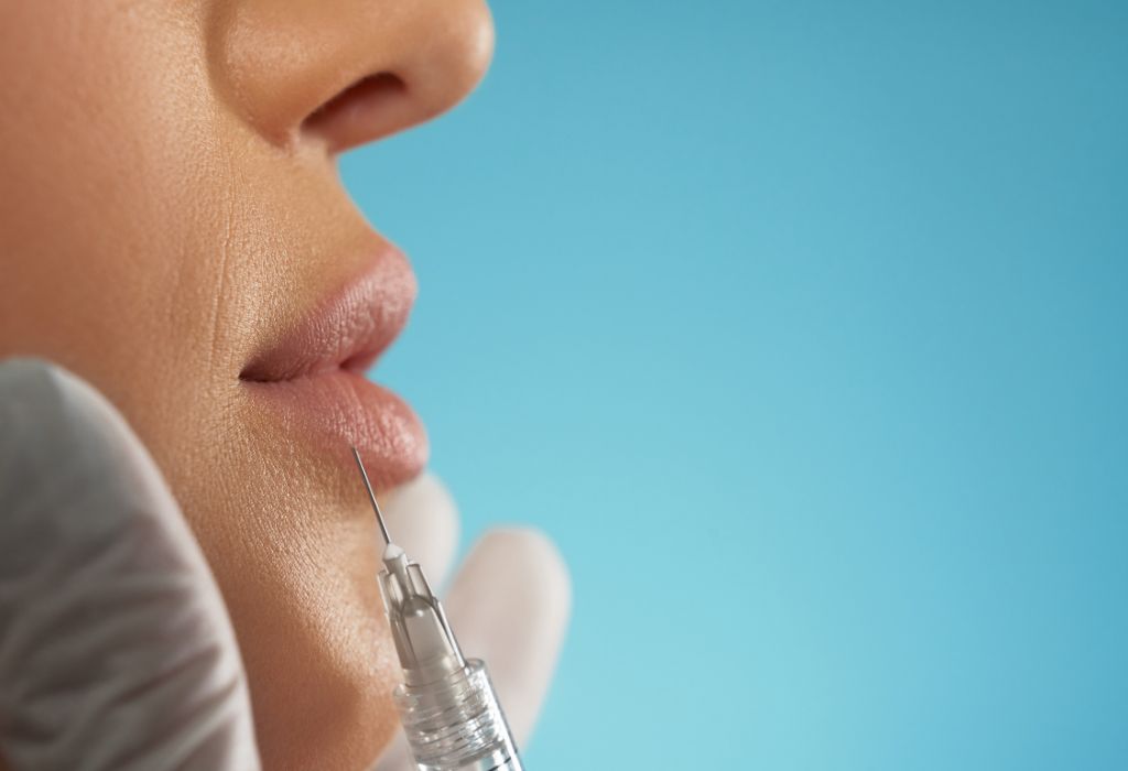 Perfilado de labios con ácido hialurónico